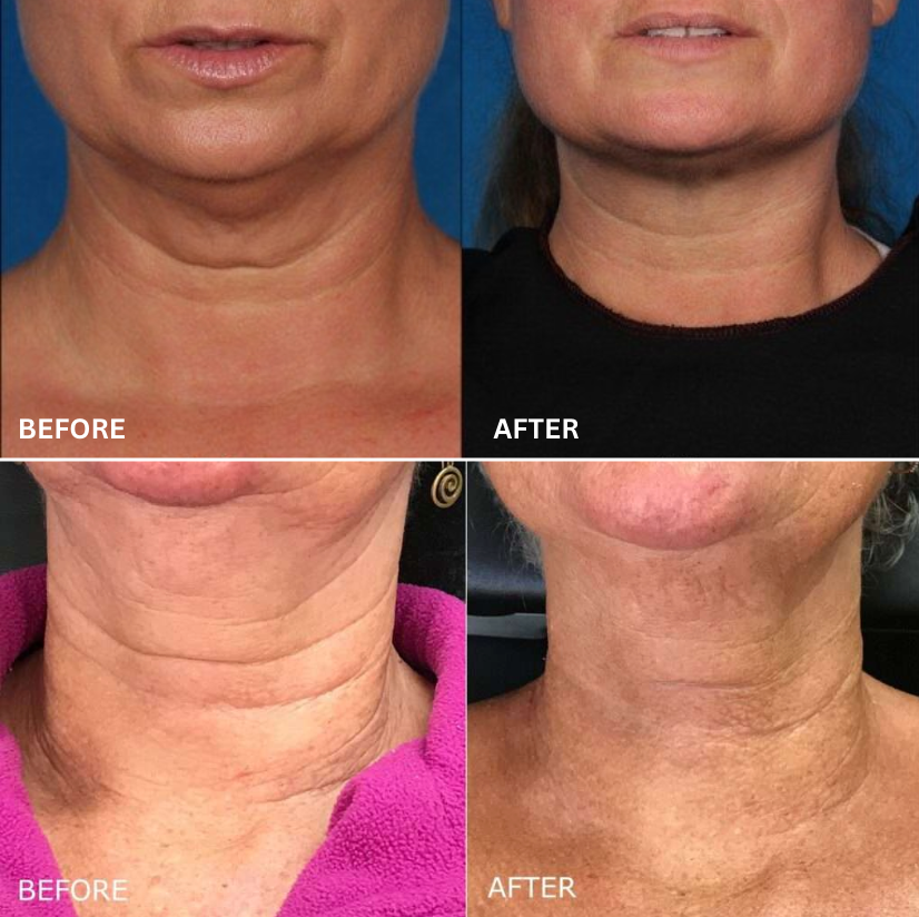 Moisturizing Neck Lifting & Firming Stick